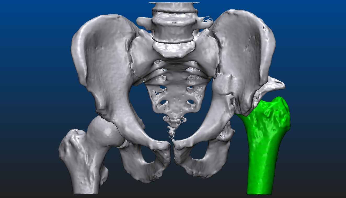 view3_010_-_current_state_-_left_femoral_head_segmented.png