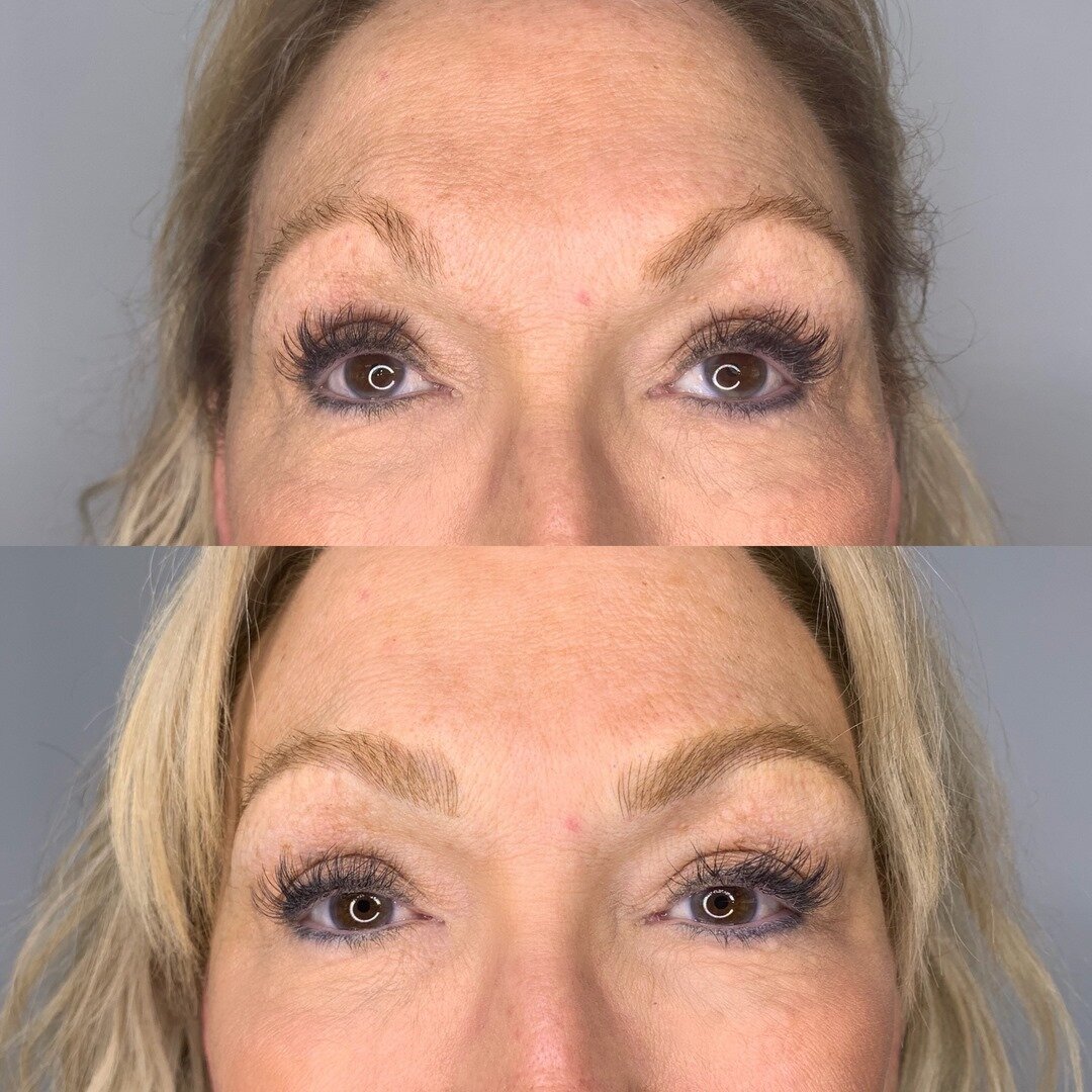 These are the kind of brows that take 2 sessions before the asymmetry can be completely corrected, but she's off to a great start