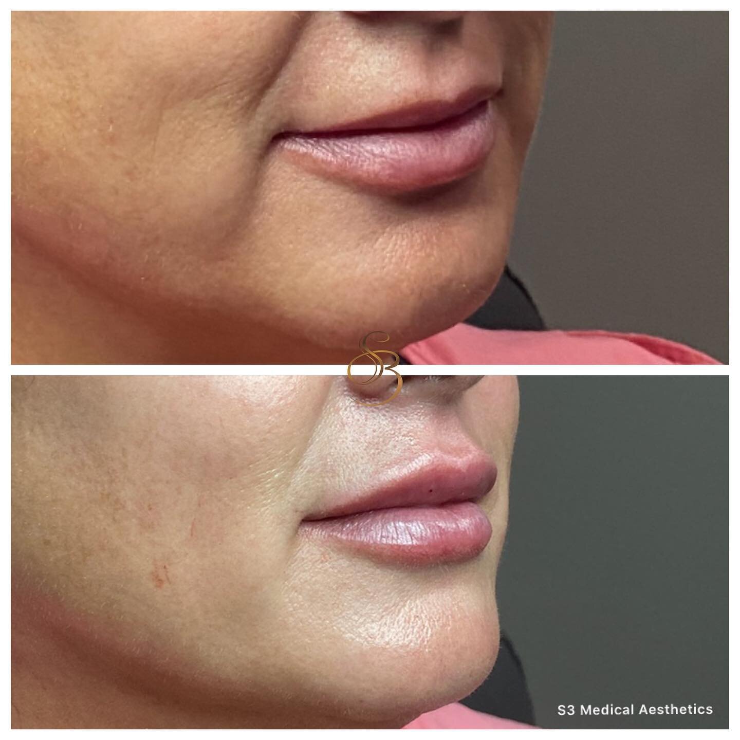 Love her results! #kysse is so beautiful in the lips. If you&rsquo;re thinking about getting your lips done, now is the time! DM or call to book a free consultation. ⁣
.⁣
.⁣
.⁣
#kysse #restylane #dermalfillers #lips #pout #sexylips #lipsbys3 #mdinjec