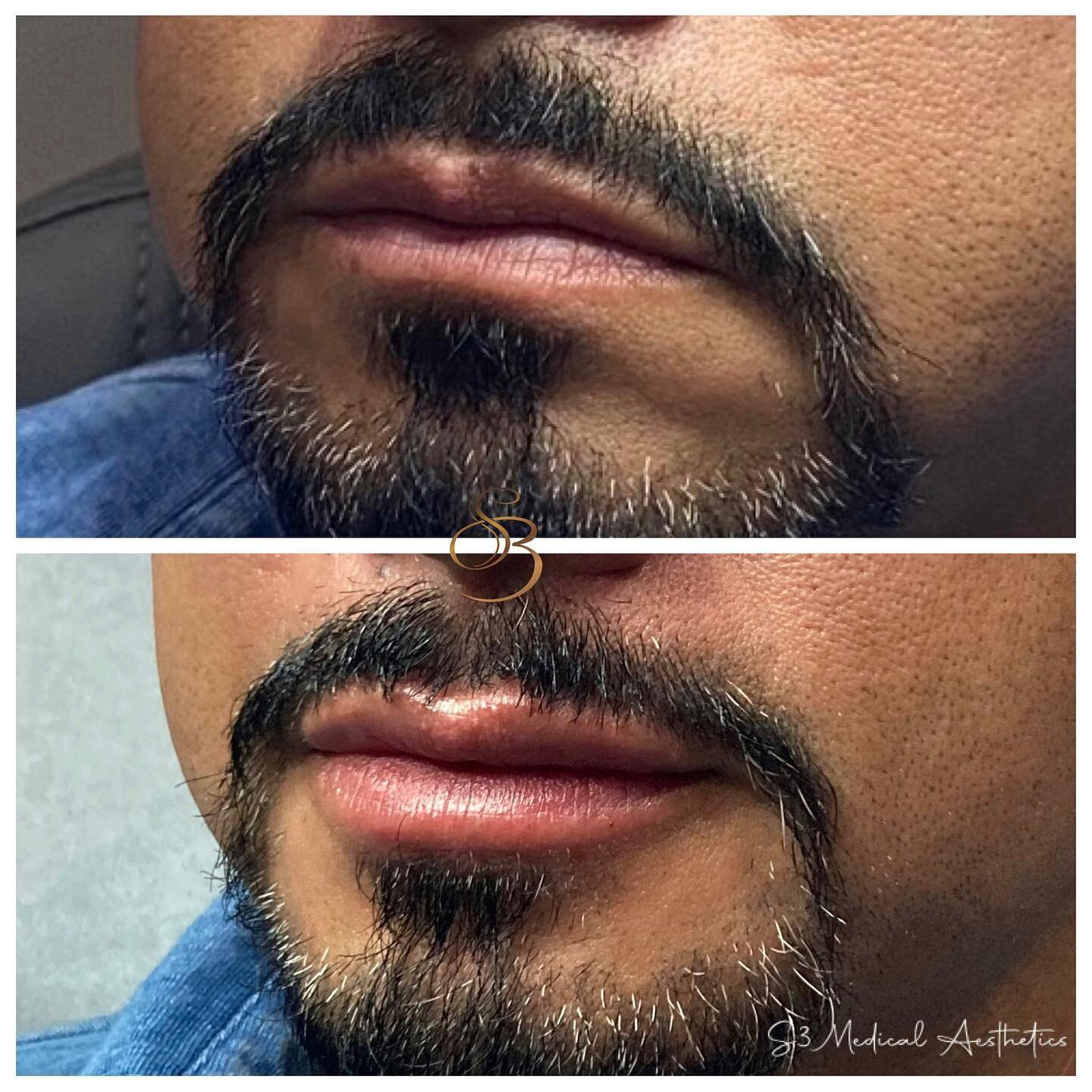 Lovely lip transformation 😍
.
.
.
#youthfullips #men #fillersformen #lipplumping #juvedermlips #mdinjector #rgv #harlingen #mcallen #medspa #juvederm #perfectlips #beforeafter #aesthetics #lipsfillers💋 #lipsfillersmen  #lipsbys3