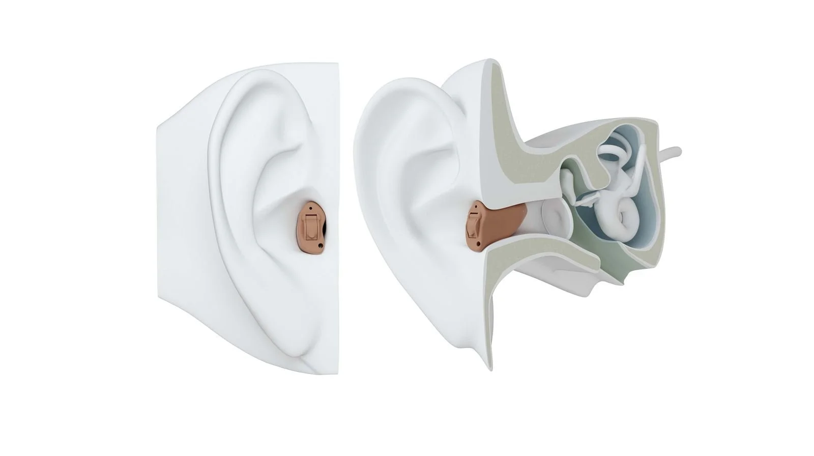 Completely in the canal hearing aid (CIC)