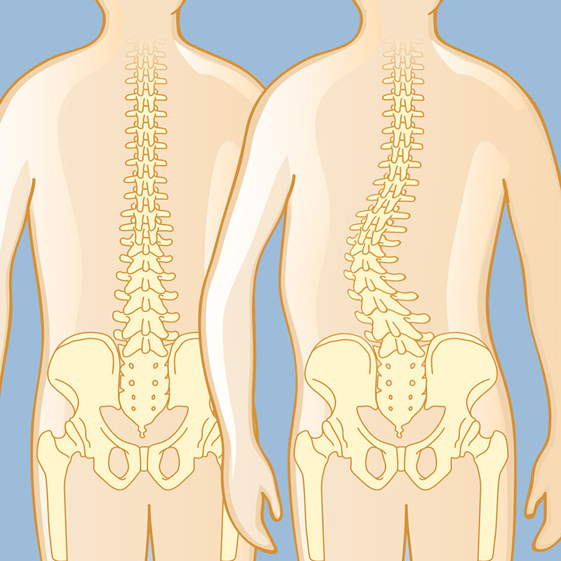 Scoliosis Treatment