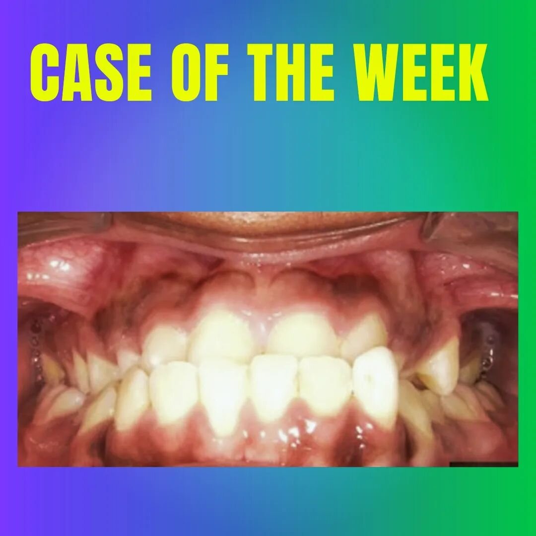 CASE OF THE WEEK! 
@padmanabhansridevi 
#orthodontic #orthodontistsofchennai #orthodontics #orthodontistsofinsta #ortho #orthodontistsofinstagram #bracesspecialist #braces #dentistsofindia #dentistsofchennai #spdentistry