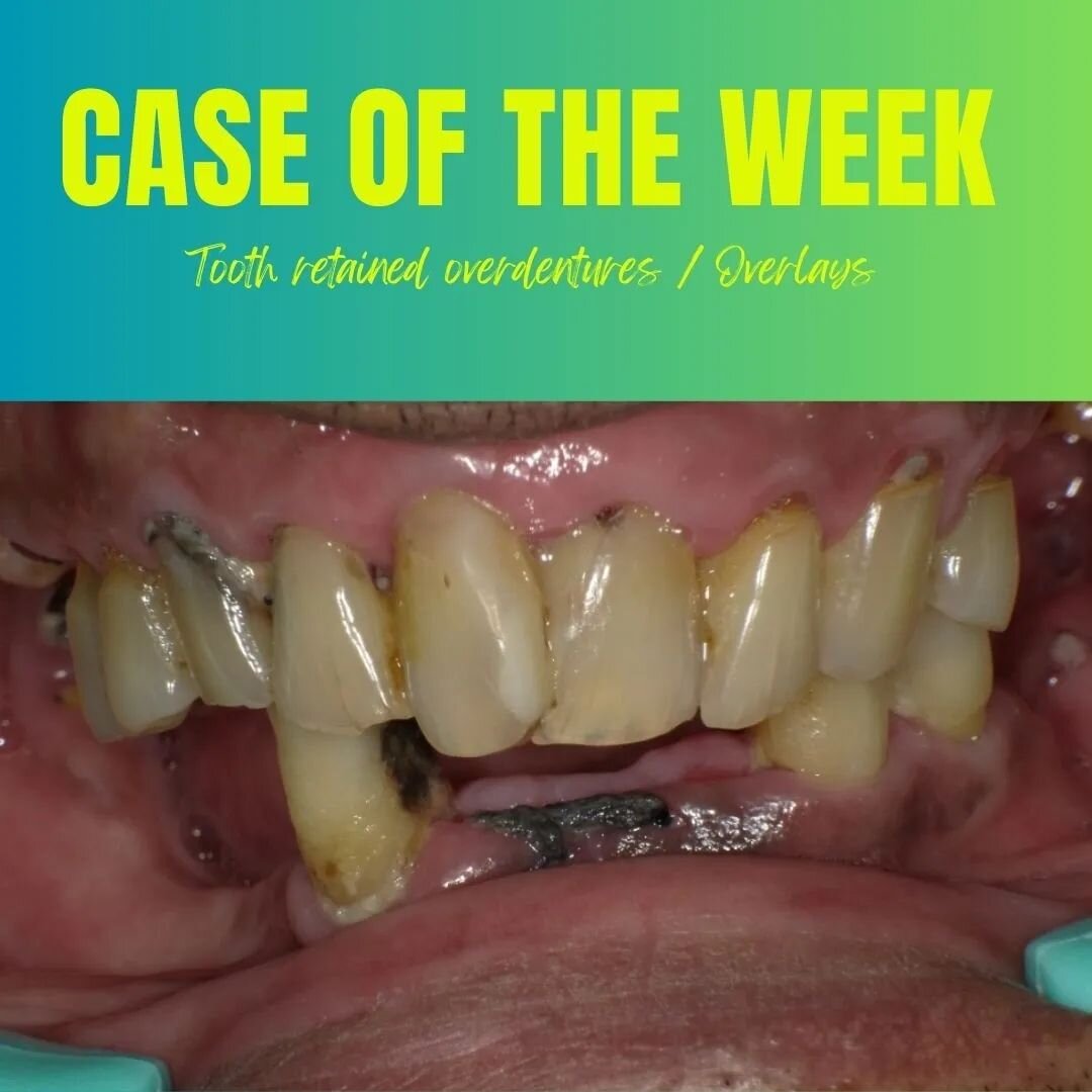 Tooth retained overdentures are a great way to preserve the residual ridge, increase the retentive of the prosthesis and most importantly give the patient the satisfaction of retaining some of his/her natural teeth. Preventive prosthodontics at its b