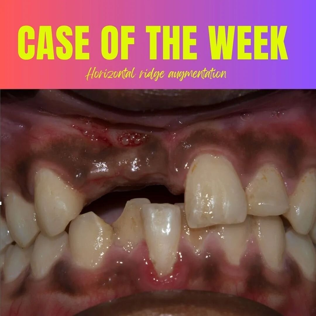 Case of the week : A case of horizontal ridge split split technique followed by implant placement 

DrTVP #dentistry #dentistsofindia #dentistsifinstagram #dentist #dentistsofchennai #prostho #prosthodontistsofinstagram #prosthodontist #prosthetic #p