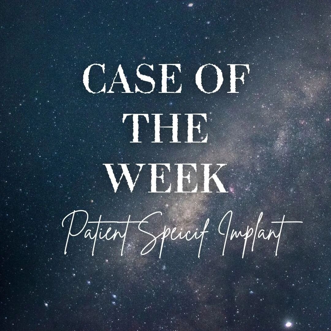 ✨The magic that is technology ✨
Check out this week's case!
This patient had had a mandibulectomy after having been diagnosed with squamous cell carcinoma of the gingiva.
The CBCT allowed the computer aided designing of a patient specific implant tha