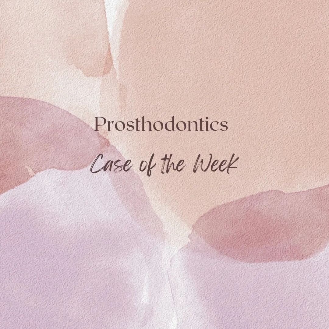 Are you ready to think outside the box when planning treatment?  Check out this week's case. 
Preventive Prosthodontics case of a periodontal prosthesis! 
A determined effort was made to find some articles but they are quite old and hard to get. If a