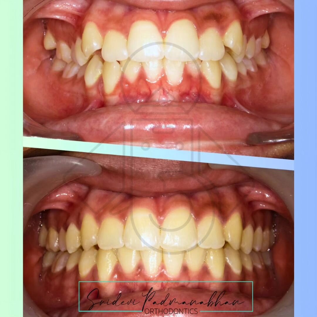 Aligners and Braces work best in the hand of Orthodontists 
Visit @dentalassociates today! 
#orthodontics #orthodontistsofchennai #orthodonticspecialist #ortho #ortho #orthodontic #dentalassociateschennai #dentist #aligners #aligner #braces #dentists