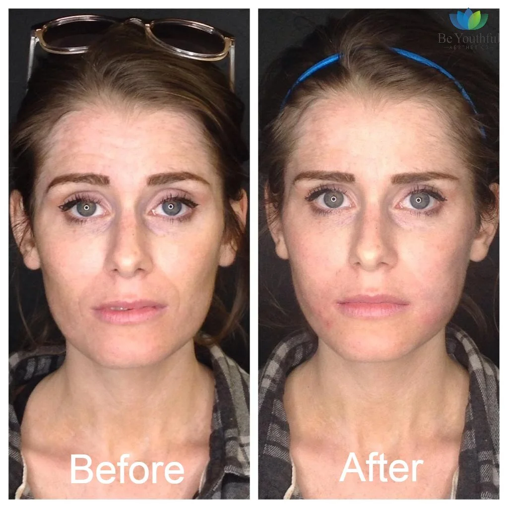 PDO Thread lift by NOVA | San Diego | Be Youthful Aesthetics — Be ...