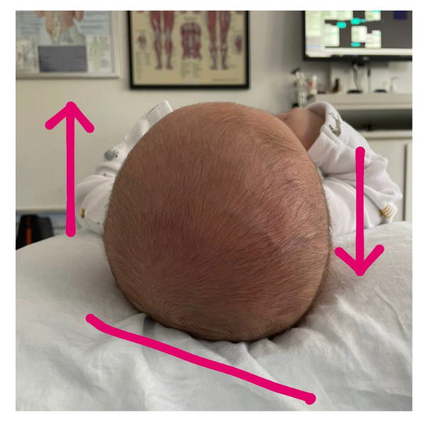 Plagiocephaly - Flat head syndrome