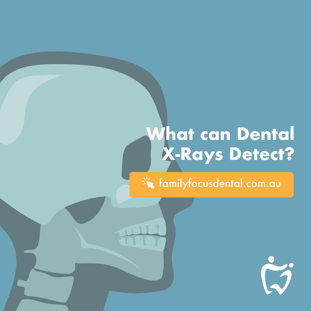 While your teeth and gums may look healthy, getting a dental X-ray can help your dentist identify hidden problem areas before they develop further. Our infographic discusses what dental x-rays can be useful for detecting.