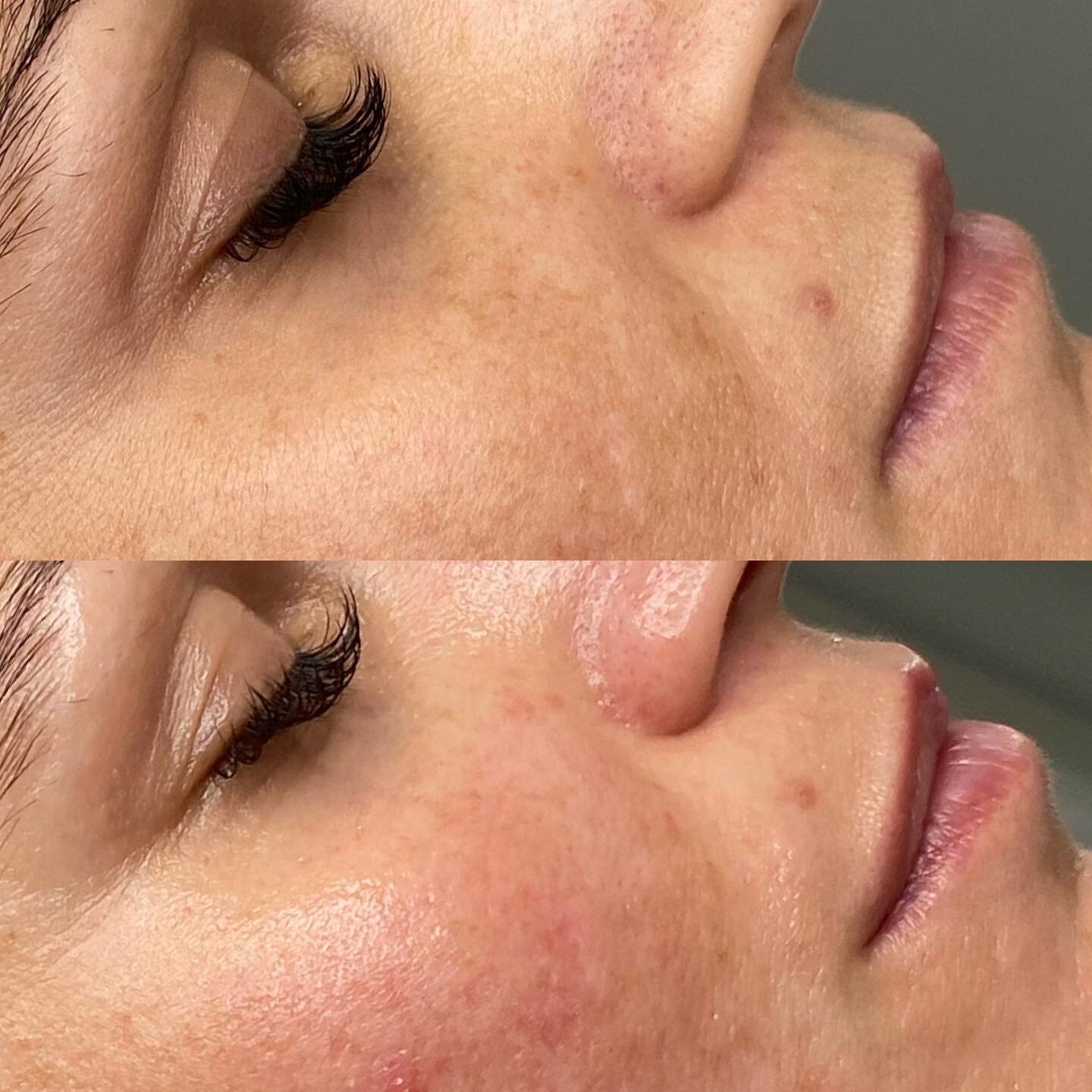 The difference between these two photos is only 90 minutes 💫

Notice the definition and lift to the lips, the plumping and lift through the naso labial folds, the lift and fullness through the cheeks. The colour and skin tone is brighter and more al