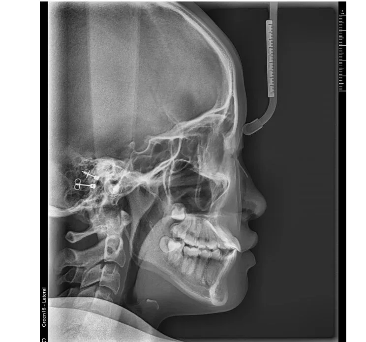 Chloe+D++X-Ray+Cephalometric.jpg