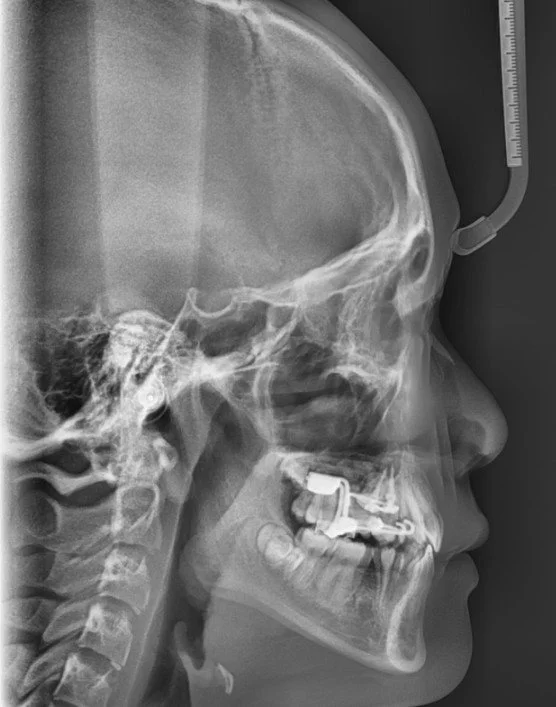 Treatment progress (Micro-Implant supported expander with facemask)