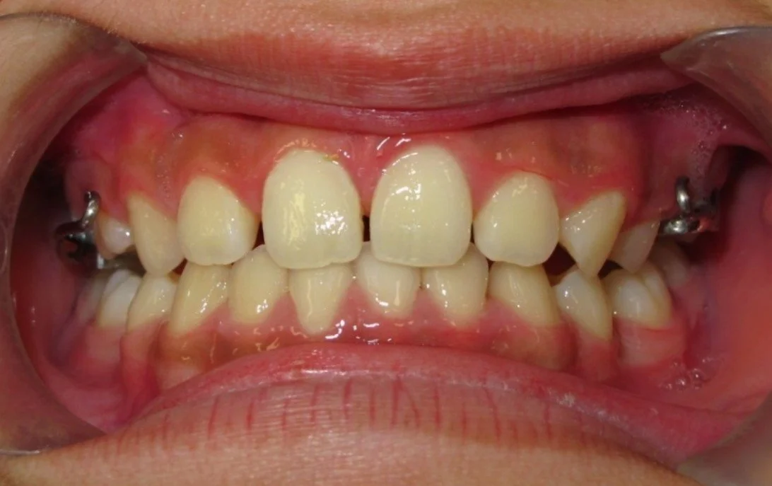 Treatment progress (Micro-Implant supported expander with facemask)