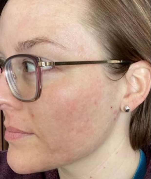 Acne Lab Panel — The Clear Skin Lab