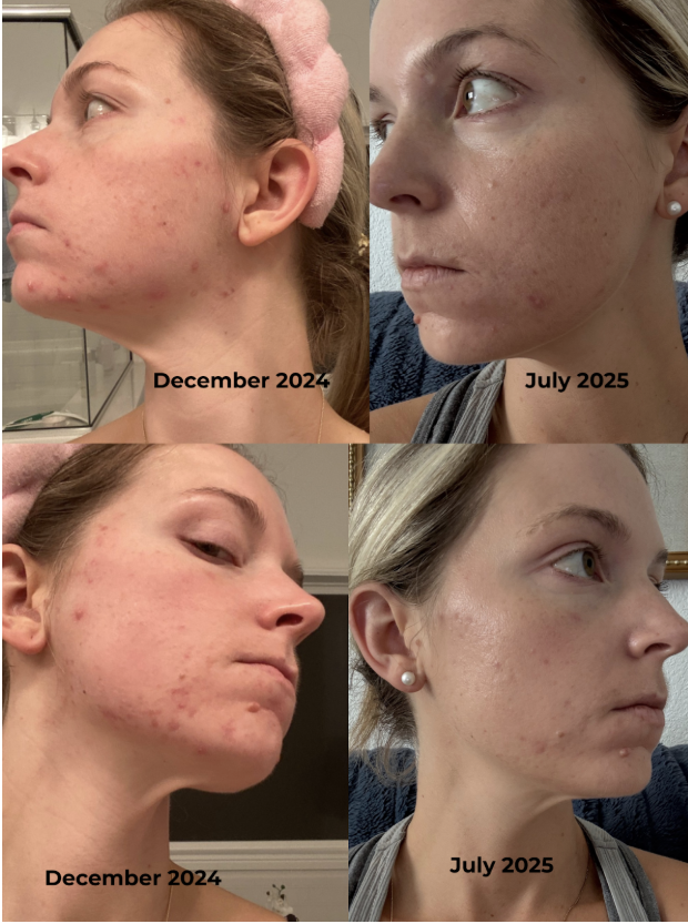 From Accutane to Answers: A Chronic Acne Healing Story Rooted in Lab Testing