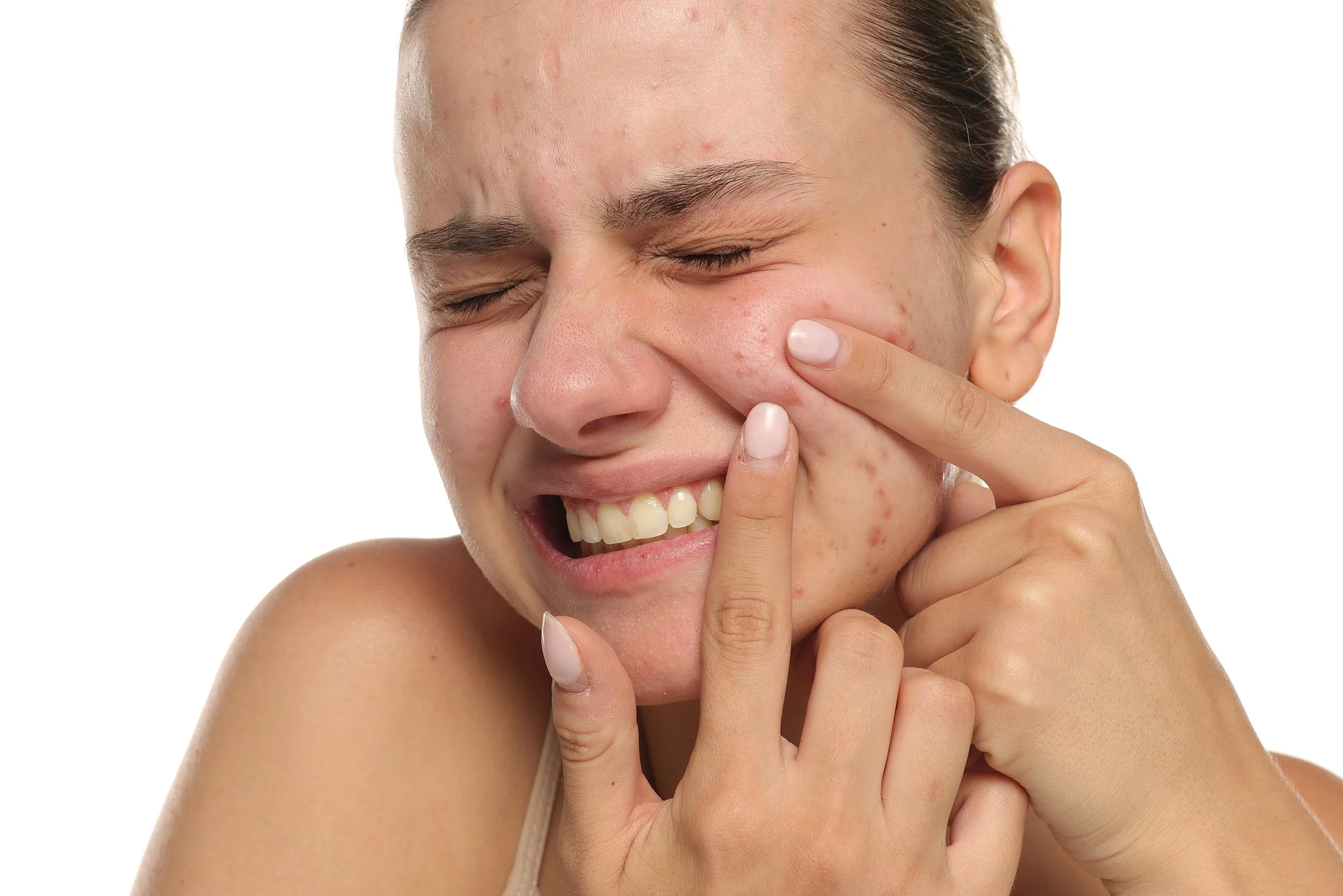 From Stress Acne Cysts to Clear Skin: What Happens When You Remove Chronic Stress