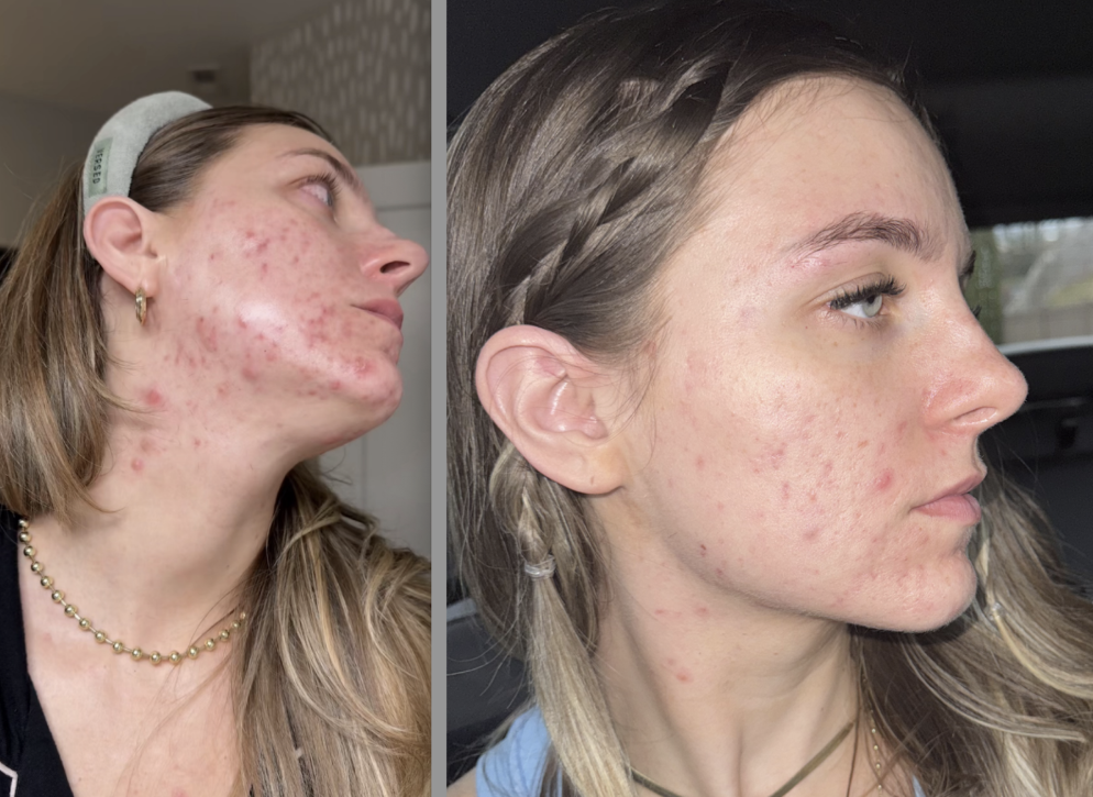 Healing Chronic Cystic Acne Naturally: A Client Story of Stress, Gut Health, and Skin Recovery