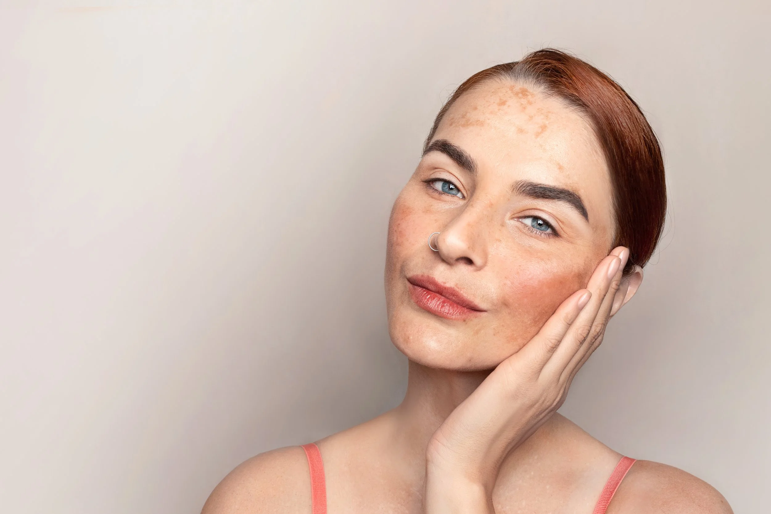 Melasma Root Causes in Women: How Hormones, Iron, and Antioxidants Shape Your Skin