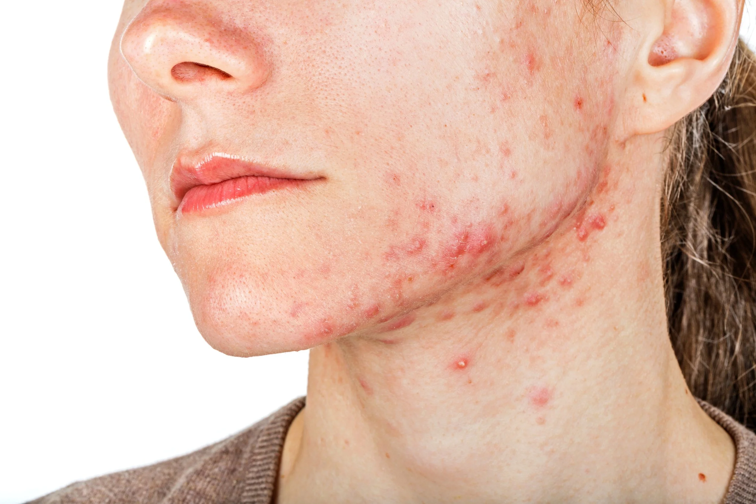 Jawline Acne and Androgens: What Your Breakouts Might Actually Be Telling You