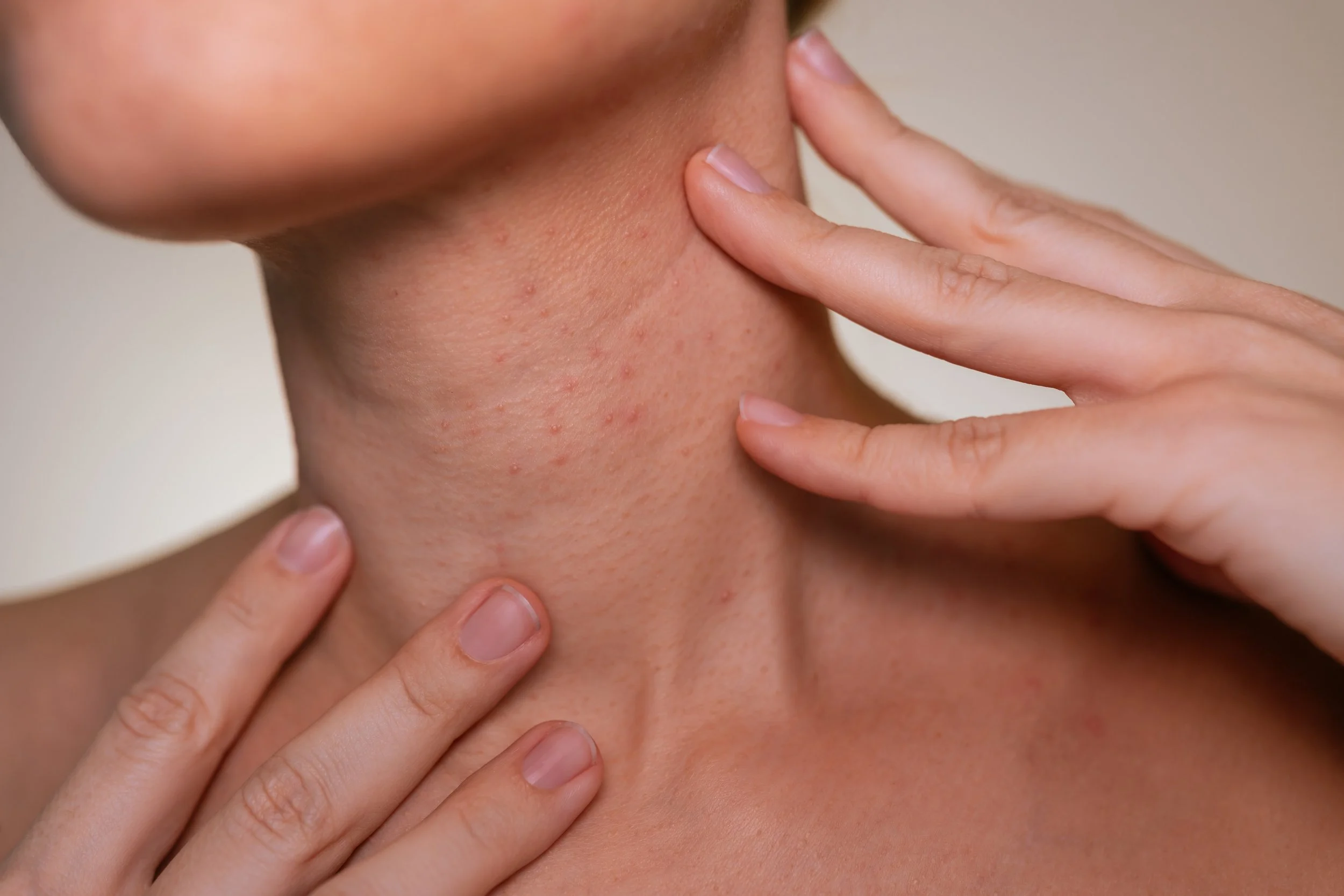 Neck Acne: The Lymph, Mineral, and Gut Connection Behind Stubborn Breakouts