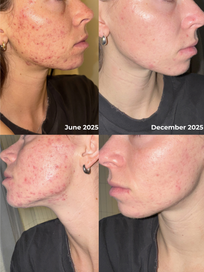 Root Cause Acne Healing: What Finally Helped Jamie Clear Her Skin Naturally