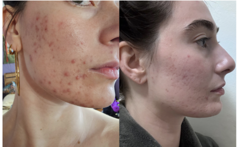 Carita’s Story: When Adult Acne Starts Affecting More Than Your Skin