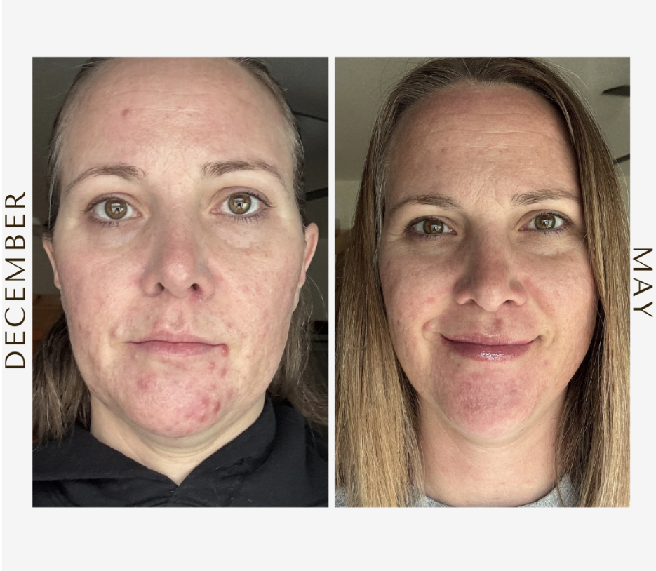 From 25 Years of Acne to a Month Without Breakouts: Jaci’s Clear Skin Journey