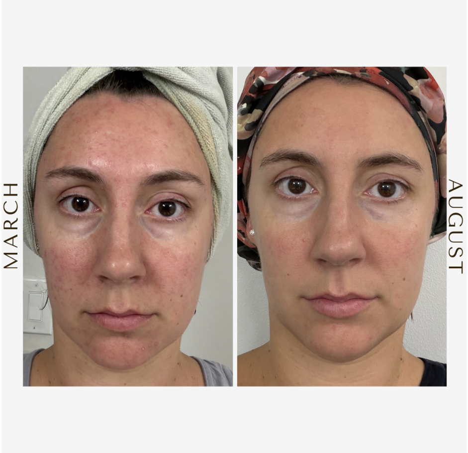 The Mom Who Finally Put Herself on the List: Tehillah’s Acne Transformation