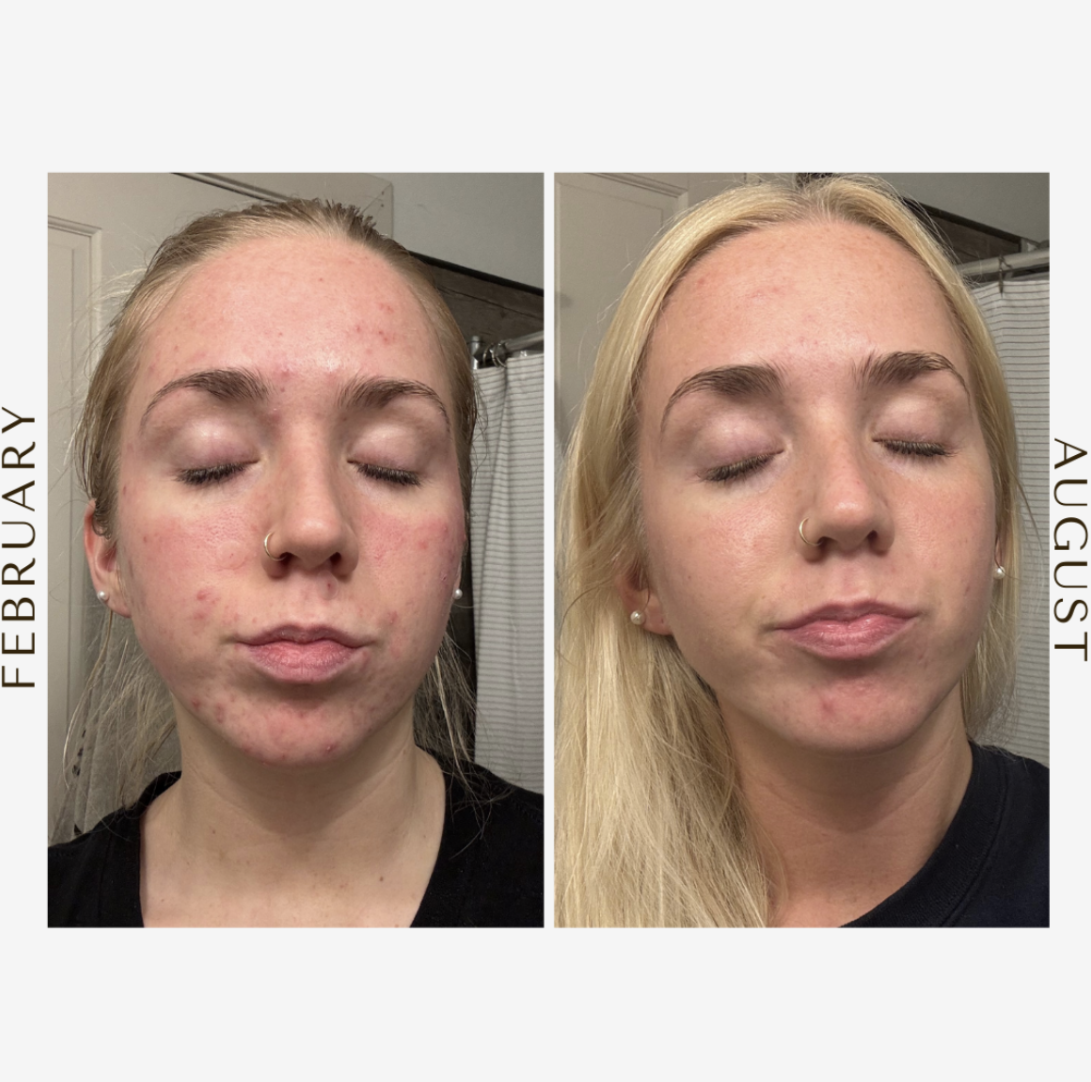 From “Valley of Despair” to Skin Confidence: Ivy’s Clear Skin Story
