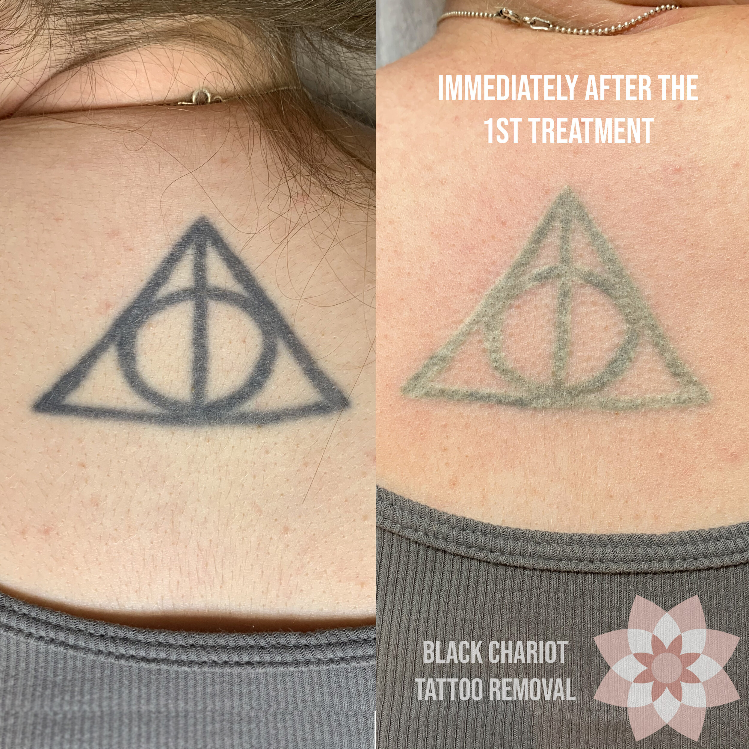 Laser removal works Patience required 3 sessions of PicoWay 10 weeks  apart  rTattooRemoval