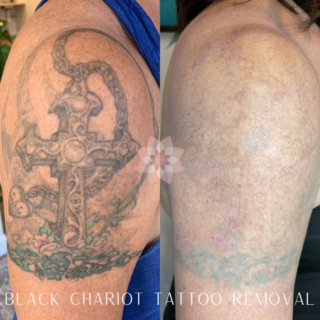 25 Tattoo Removal Before And After Photos