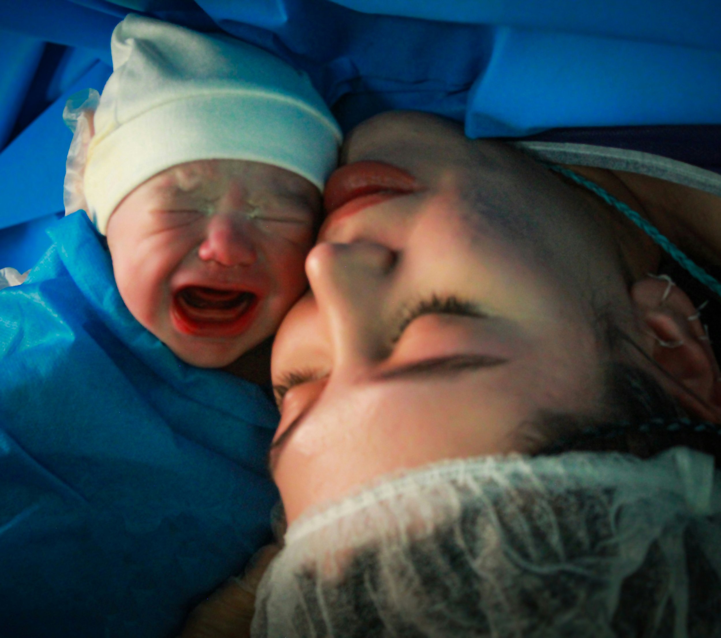 Acupuncture After C-Section: A Safe Path to Faster Recovery and Pain Relief