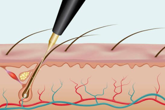 Everything You Need to Know Before Your First Electrolysis Appointment