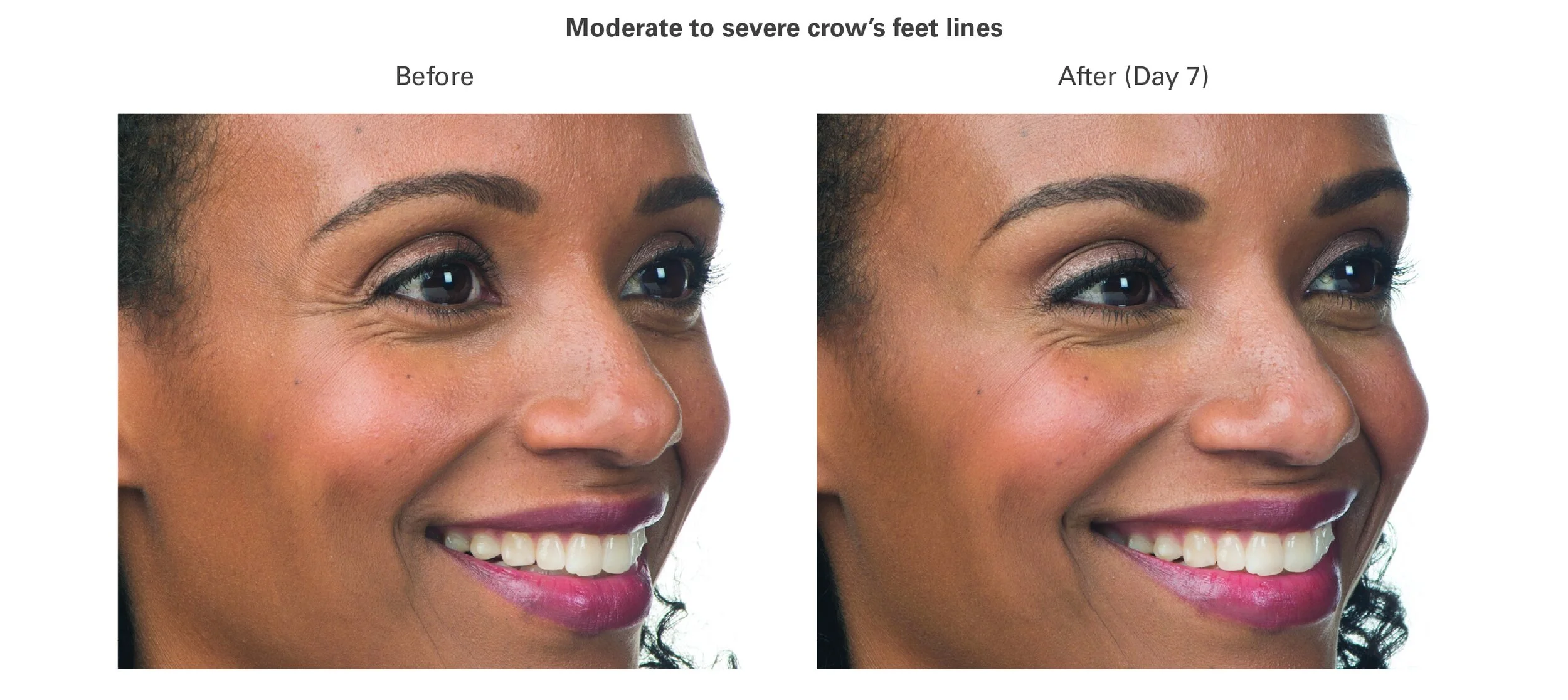 Botox Treatments Still Well by Dr. Stilwell Staten Island, NY