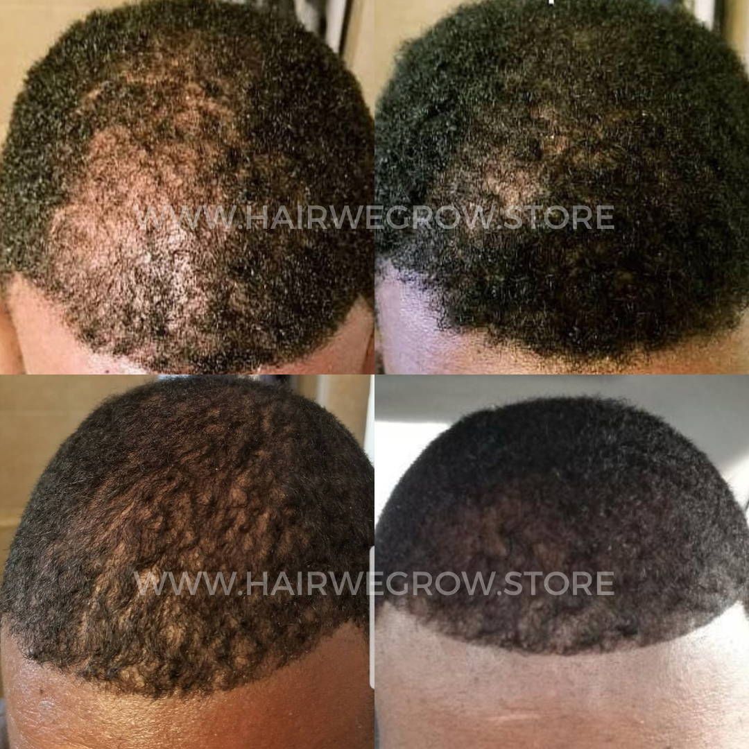 Hair we Gro hair loss recovery before and after results