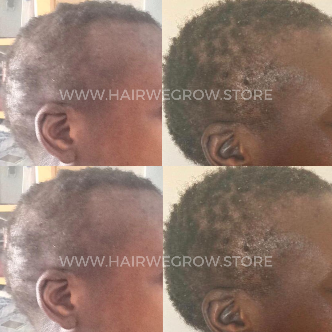 Hair we Gro hair loss recovery before and after results