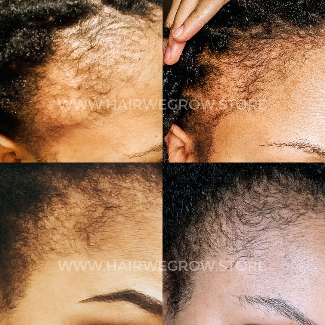 Hair we Gro before and after results