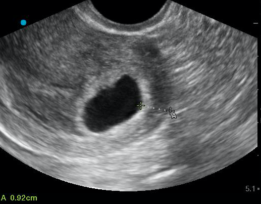Figure 5. Measurement of the endomyometrial mantle