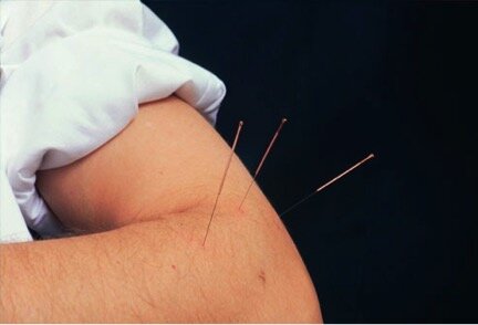 Dry Needling.jpg