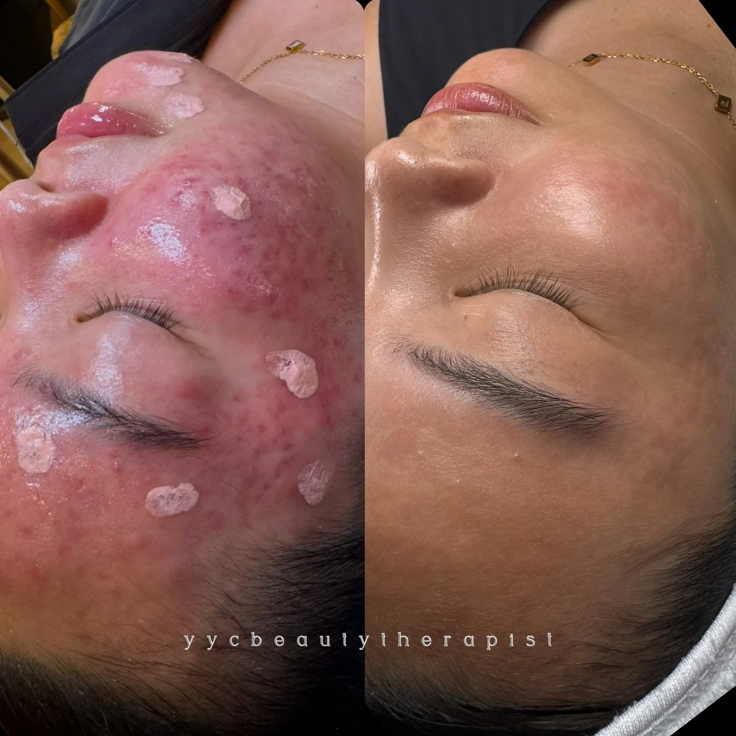 The most rewarding part of being an aesthetician is the ✨✨TRANSFORMATION!✨✨

These results don't happen over night. This is almost two years of dedication to a specific product regimen and custom treatments. 
 

#yyc #yycbeauty #yycsmallbusiness #yyc
