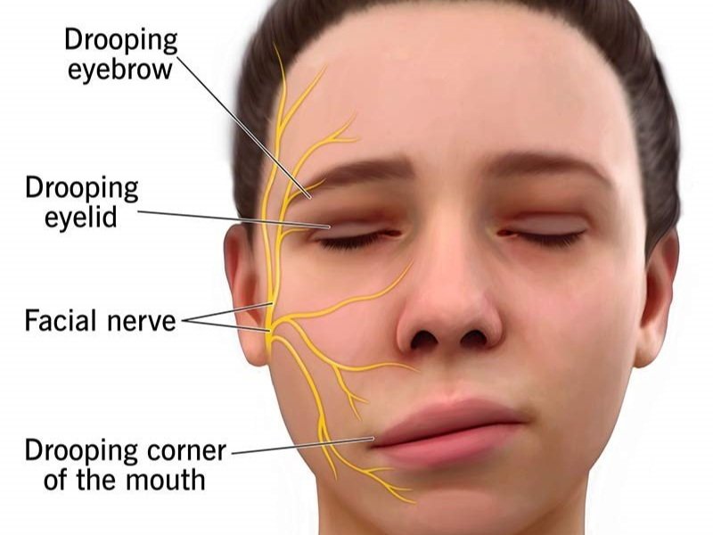 Physiotherapy for Facial Palsy