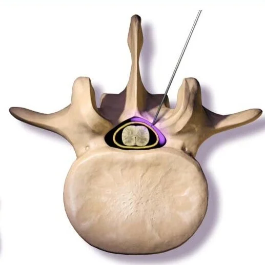 Herniated Disc — EPIC PAIN MANAGEMENT