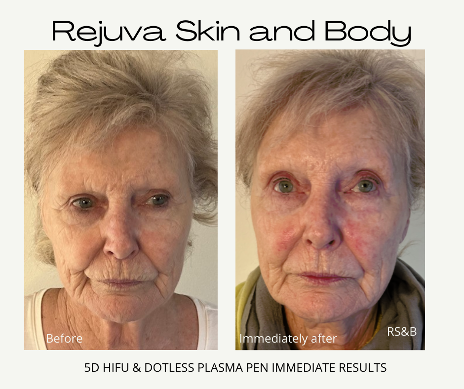 HIFU NONSURGICAL FACELIFT PERTH Stayperfect, 51 OFF