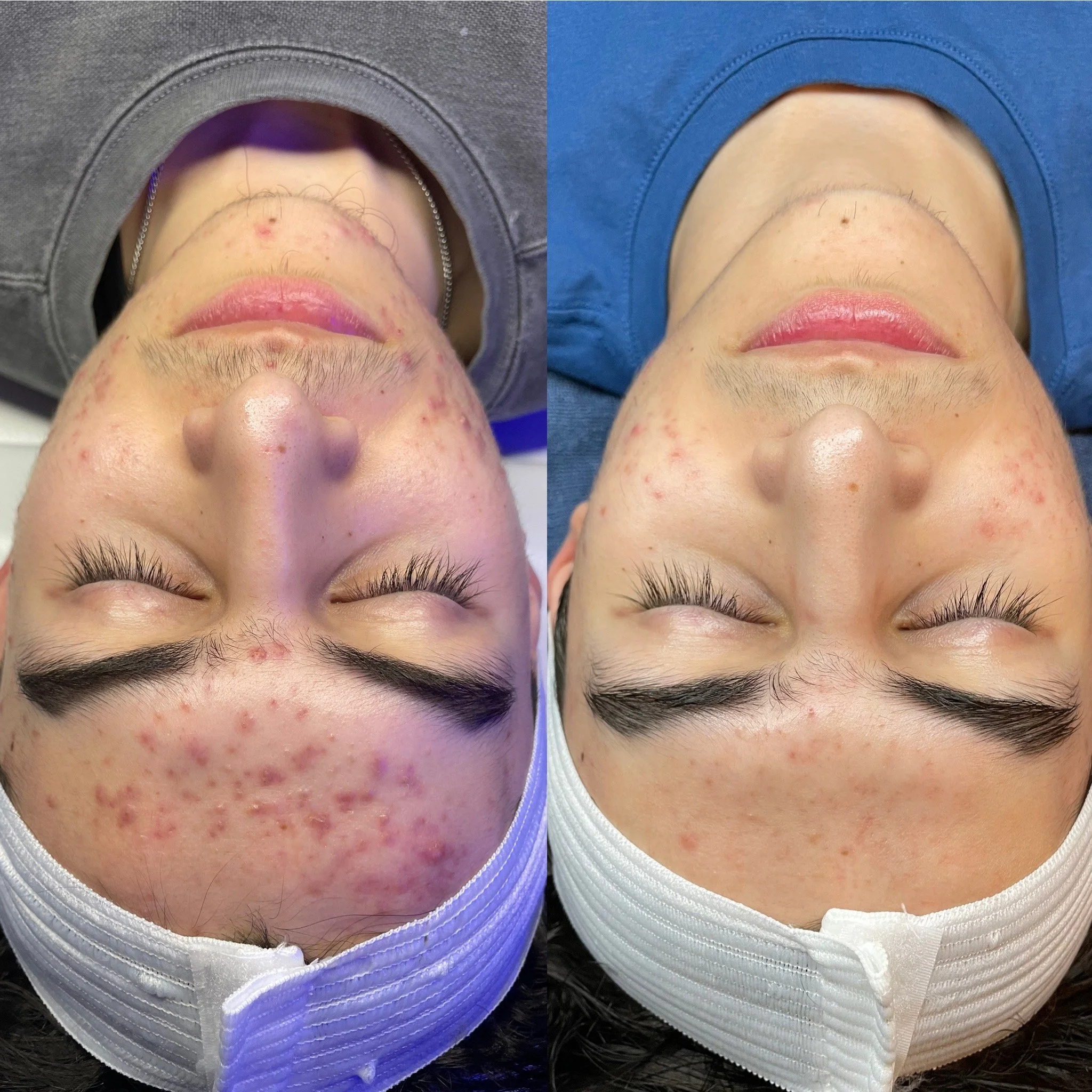 Top rated acne specialist Kansas City