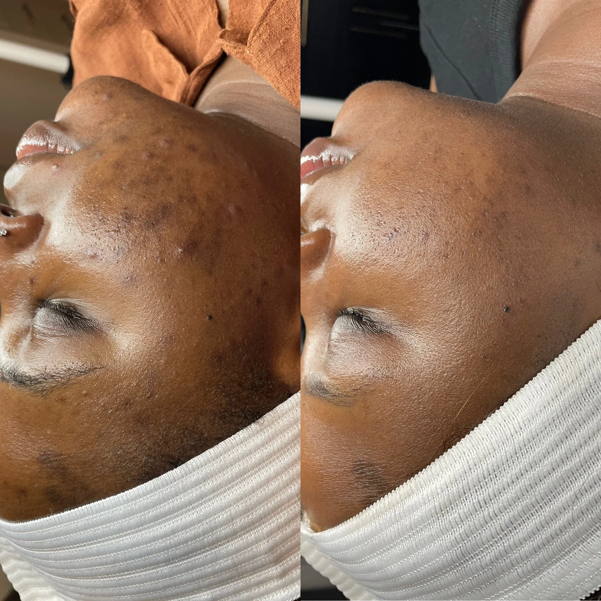 Hyperpigmentation on the Face: Causes, Treatments, and Professional Solutions