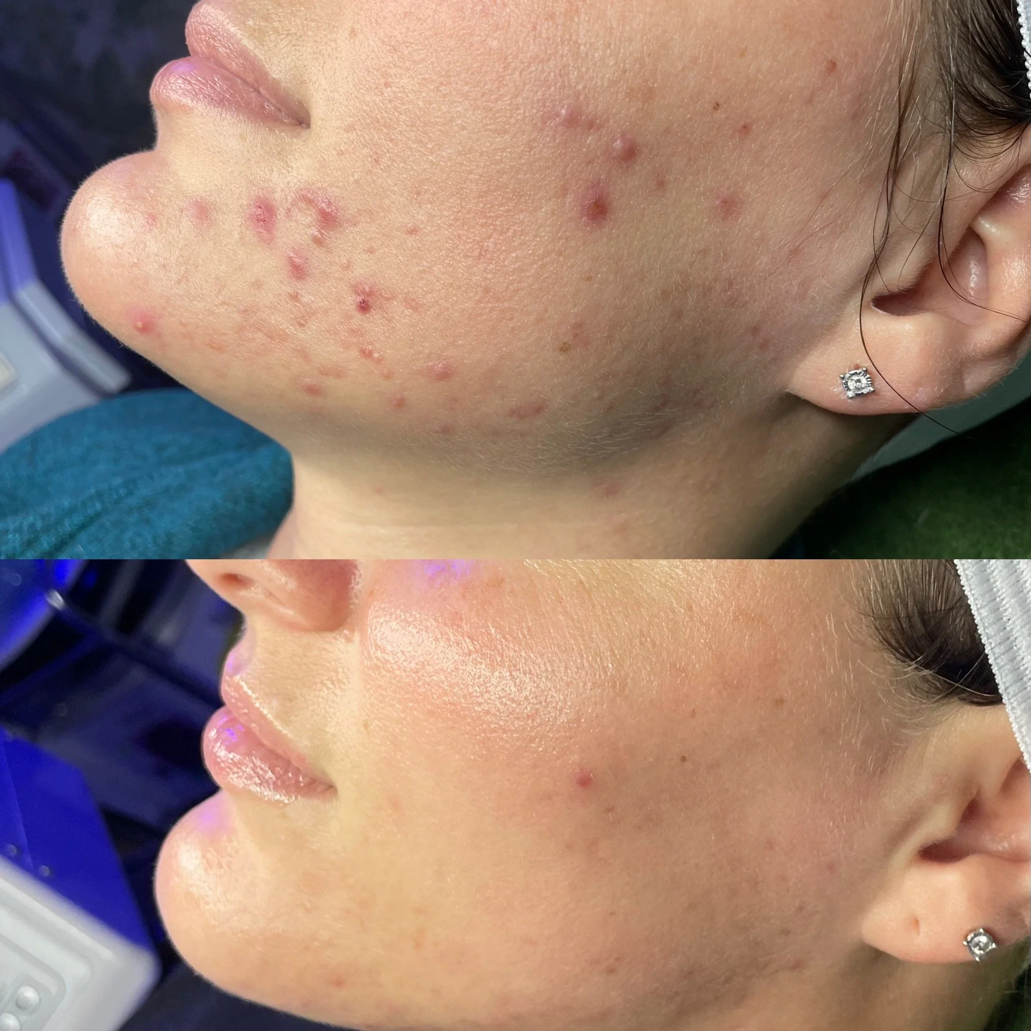 Best acne specialist Kansas City