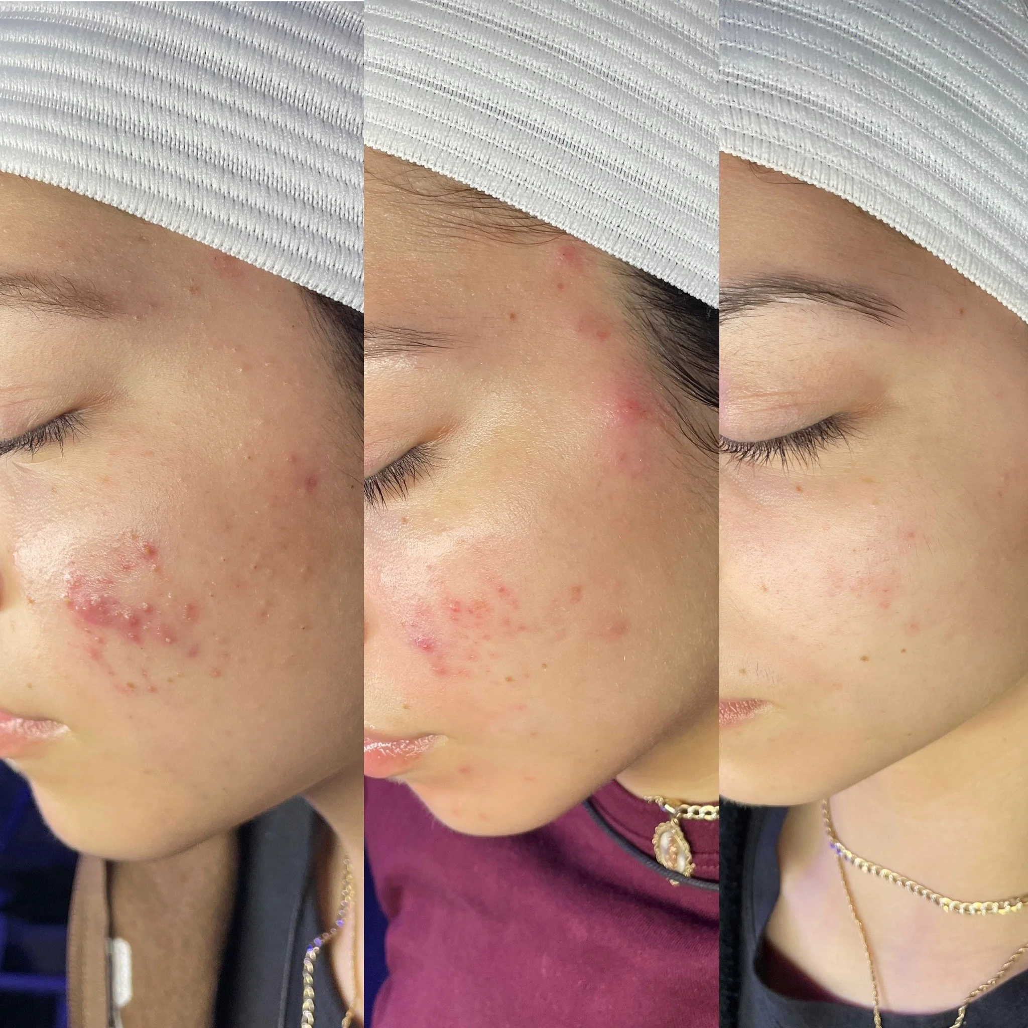 Corrective facial Kansas City