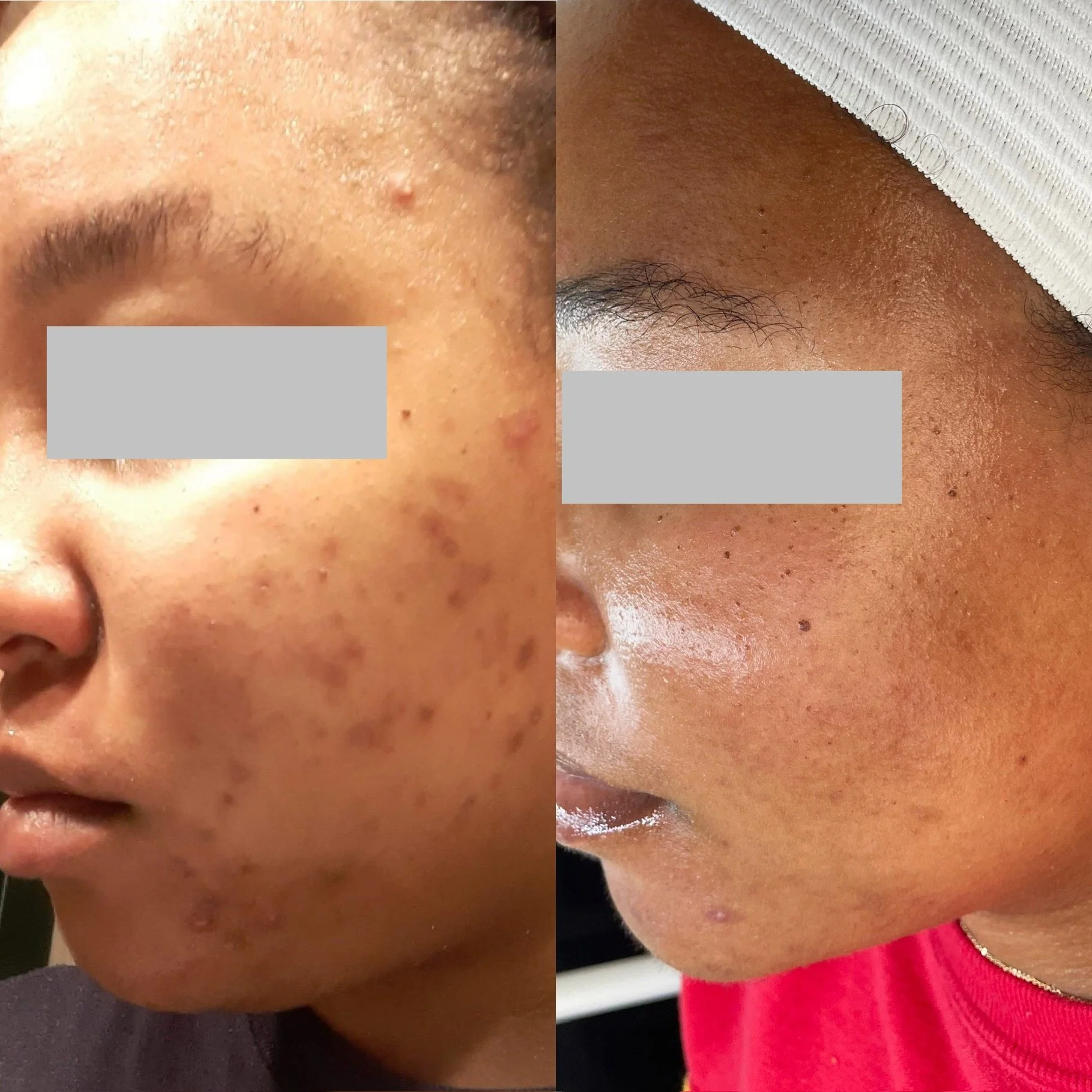 Chemical peel results Kansas City